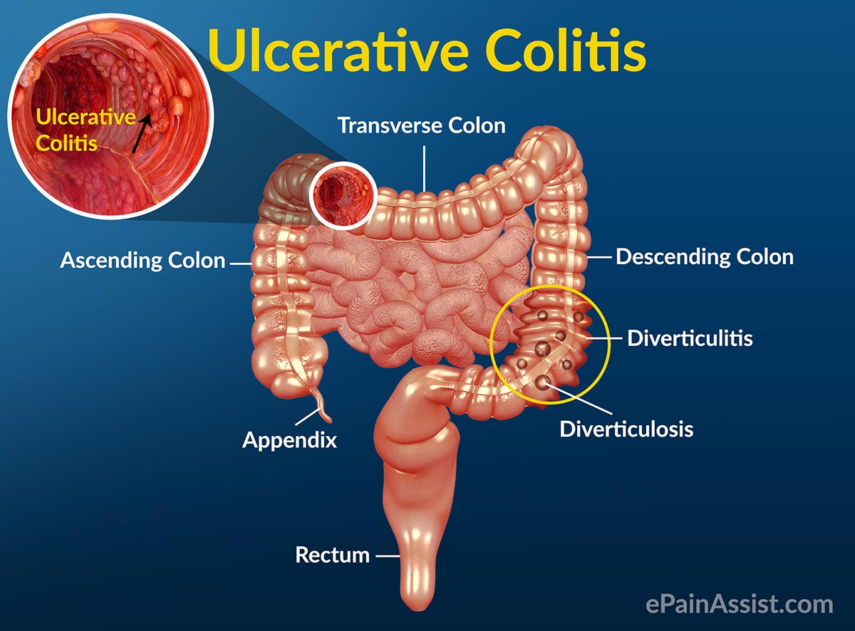 Understanding Ulcerative Colitis Half Tablespoon