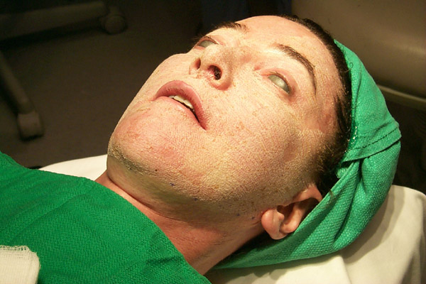 My Experience with Laser Skin Resurfacing