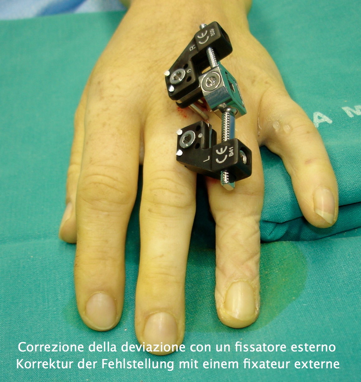 Fratture e distorsioni della mano Dr. Frank NienstedtDr