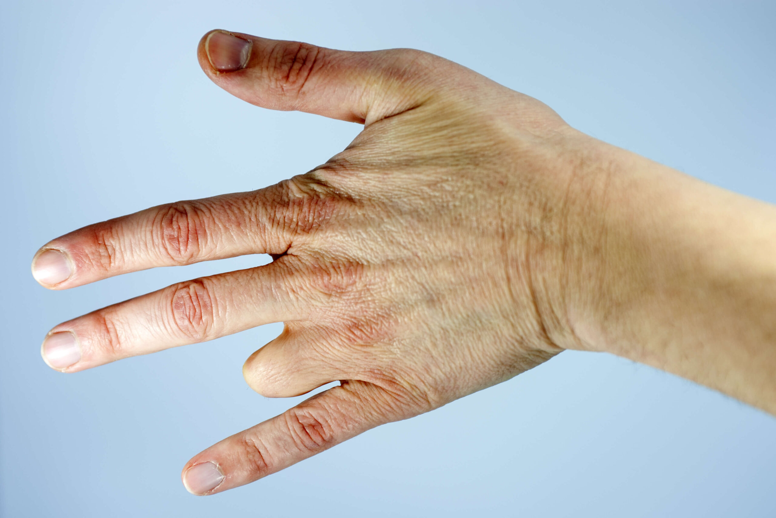 Finger Amputation Surgery Dallas Hand Surgeons Dr. AzouzAzouz Hand