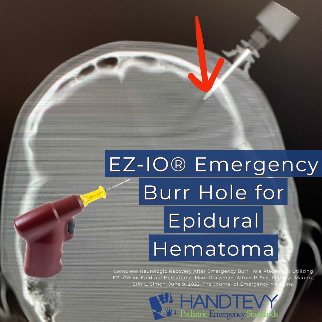 EZIO® Emergency Burr Hole for Epidural Hematoma Handtevy