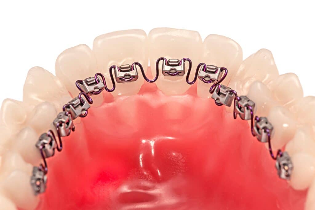 INBRACE in Brooklyn NY Hanson Place Orthodontics
