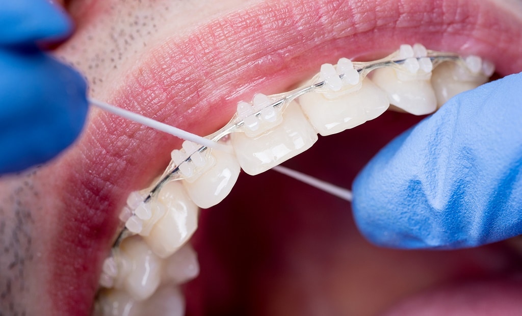 Flossing with Braces Expert Tips from Hanson Place Orthodontics