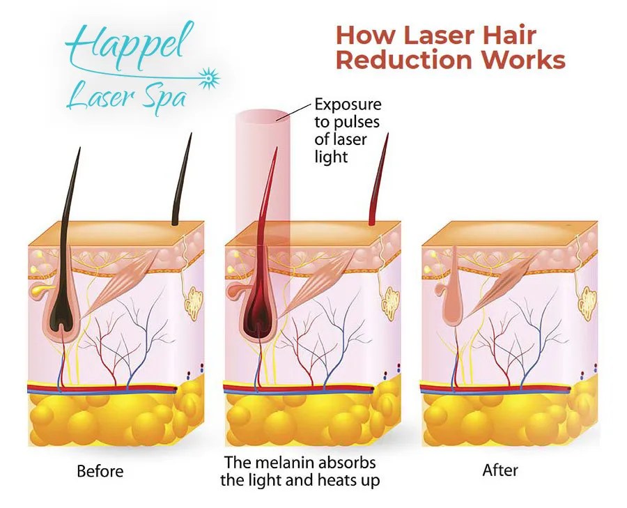 How Laser Hair Reduction Works Happel Laser Spa Best Pittsburgh