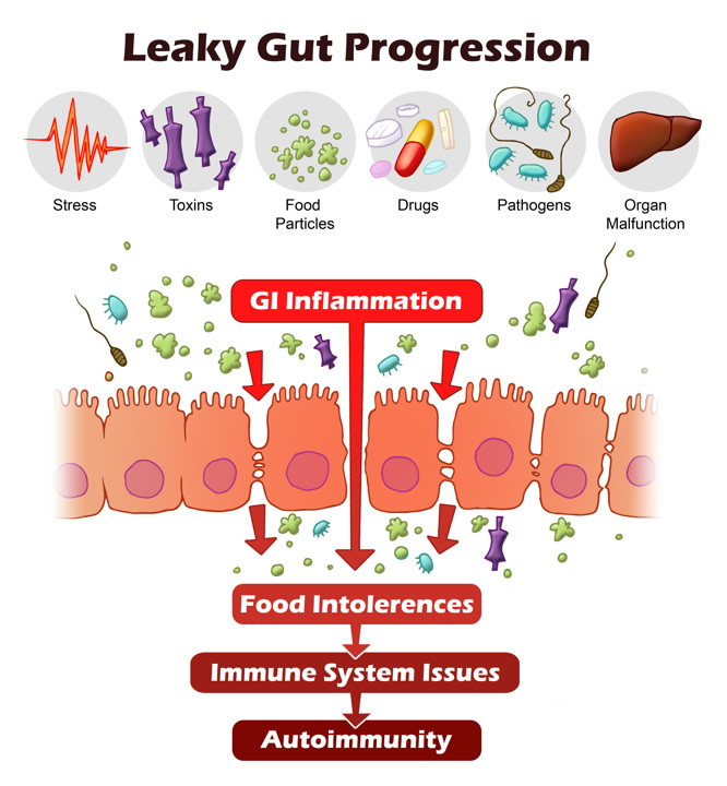 Leaky Gut and Irritable Bowel Syndrome