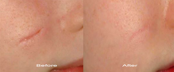 Laser Scar Removal in Oshawa Harmony MedSpa