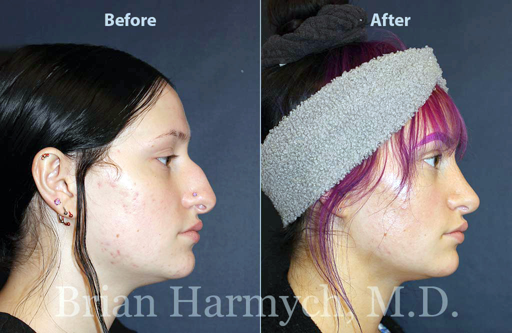 How much does a nose job or rhinoplasty cost?