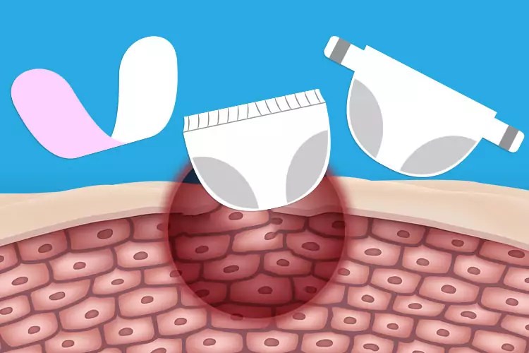 Preventing and Treating Incontinence Dermatitis—Home Care Delivered