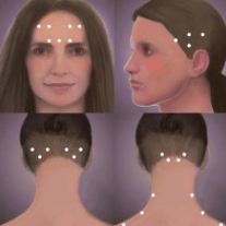 Superficial reddening of the skin; Botox Injections Paris Tn Hcmc Henry County Medical Center