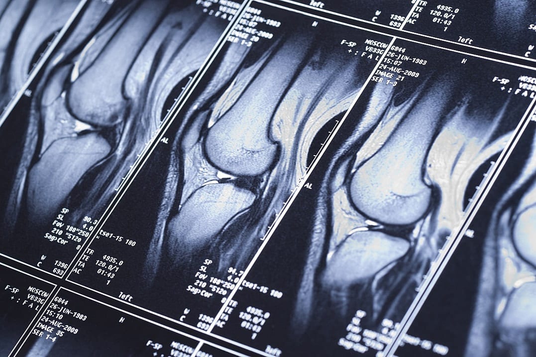 ACL Tear Reconstruction in Singapore Knee Surgeon Guide