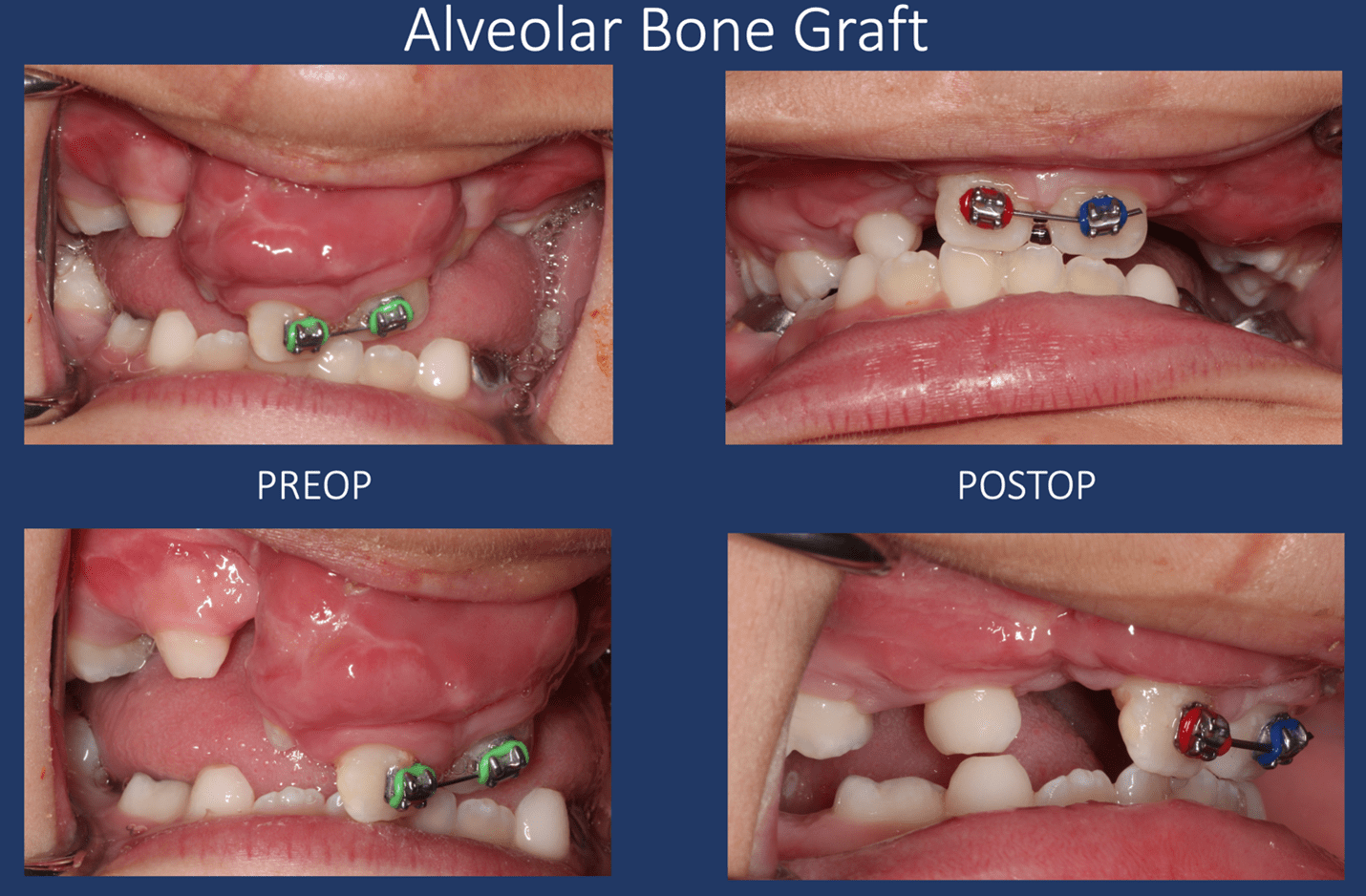 Before and After Gallery Cleft Palate Surgeon El Paso TX
