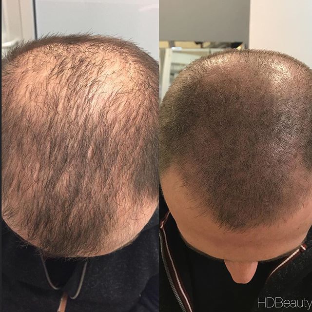 Six Things You Need to Know about Scalp Micropigmentation HD Beauty