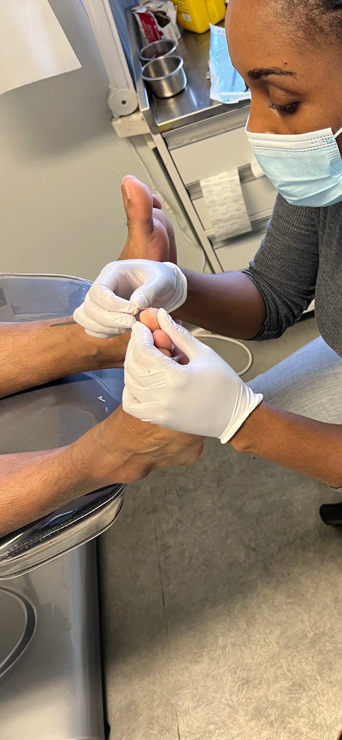 Corn Removal Head 2 Toe