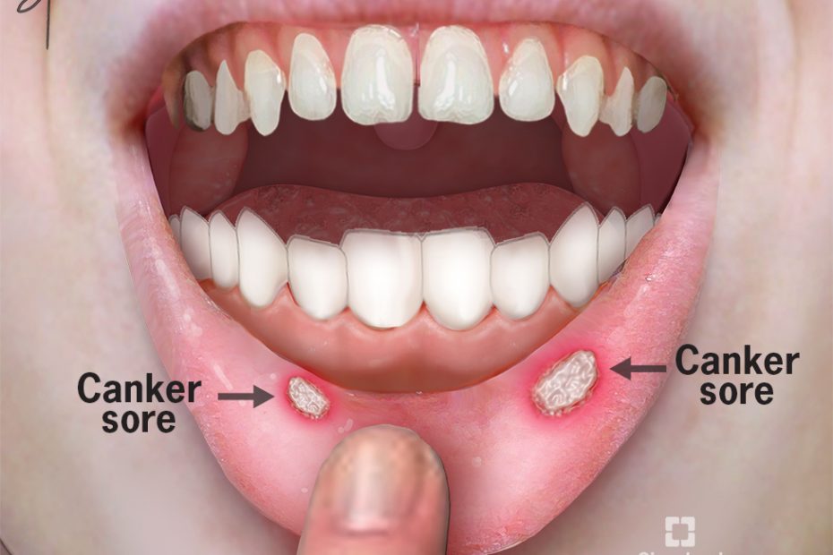 MOUTH ULCERS (CANKER SORES)