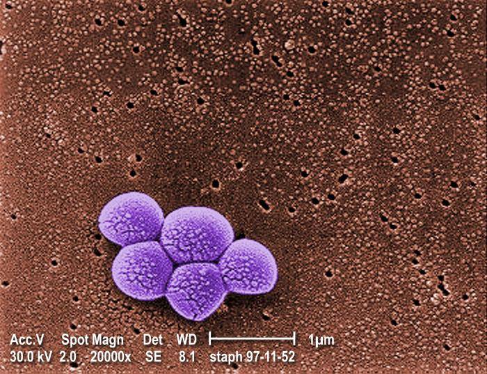 MRSA Staph Infection, Superbug (CAMRSA, HAMRSA) Pictures