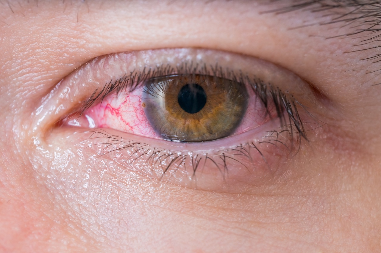 How Do You Treat Pink Eye? Healthizen