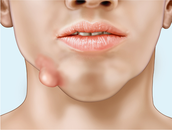 Diagnosis, Causes, and Treatments of Carbuncles