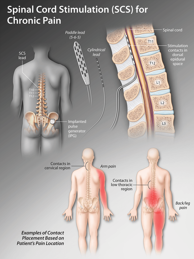 Spinal Cord Stimulation An Underutilized and Underrecognized Pain
