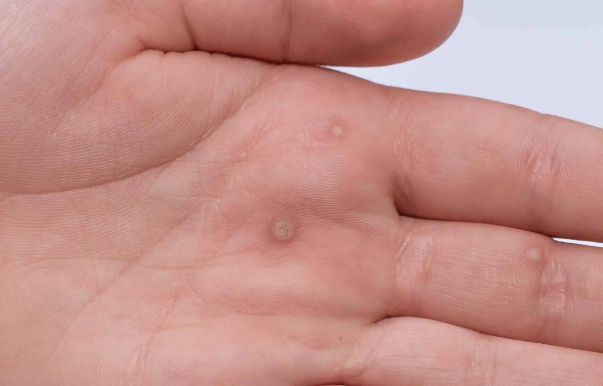 Answers to Frequently Asked Questions About Warts Health Tenfold