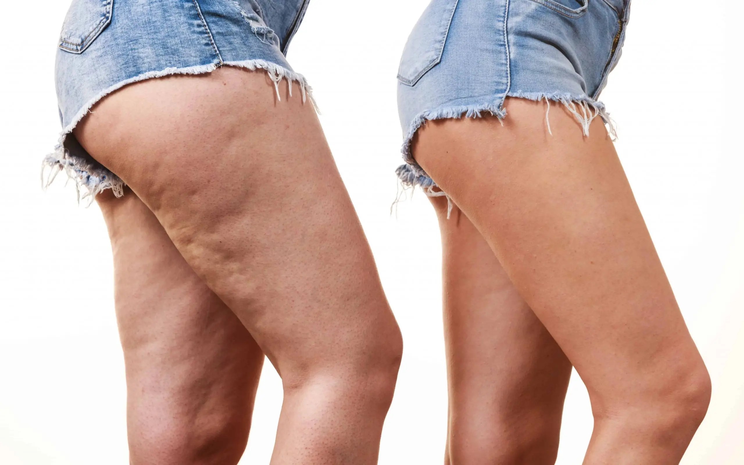 What Causes Cellulite And How To Get Rid Of It Fast - Health Tenfold