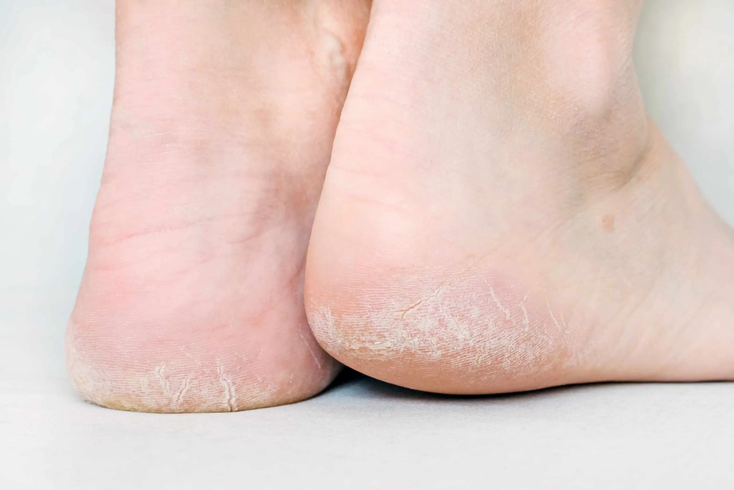 What causes cracked heels prevention and the best home remedies