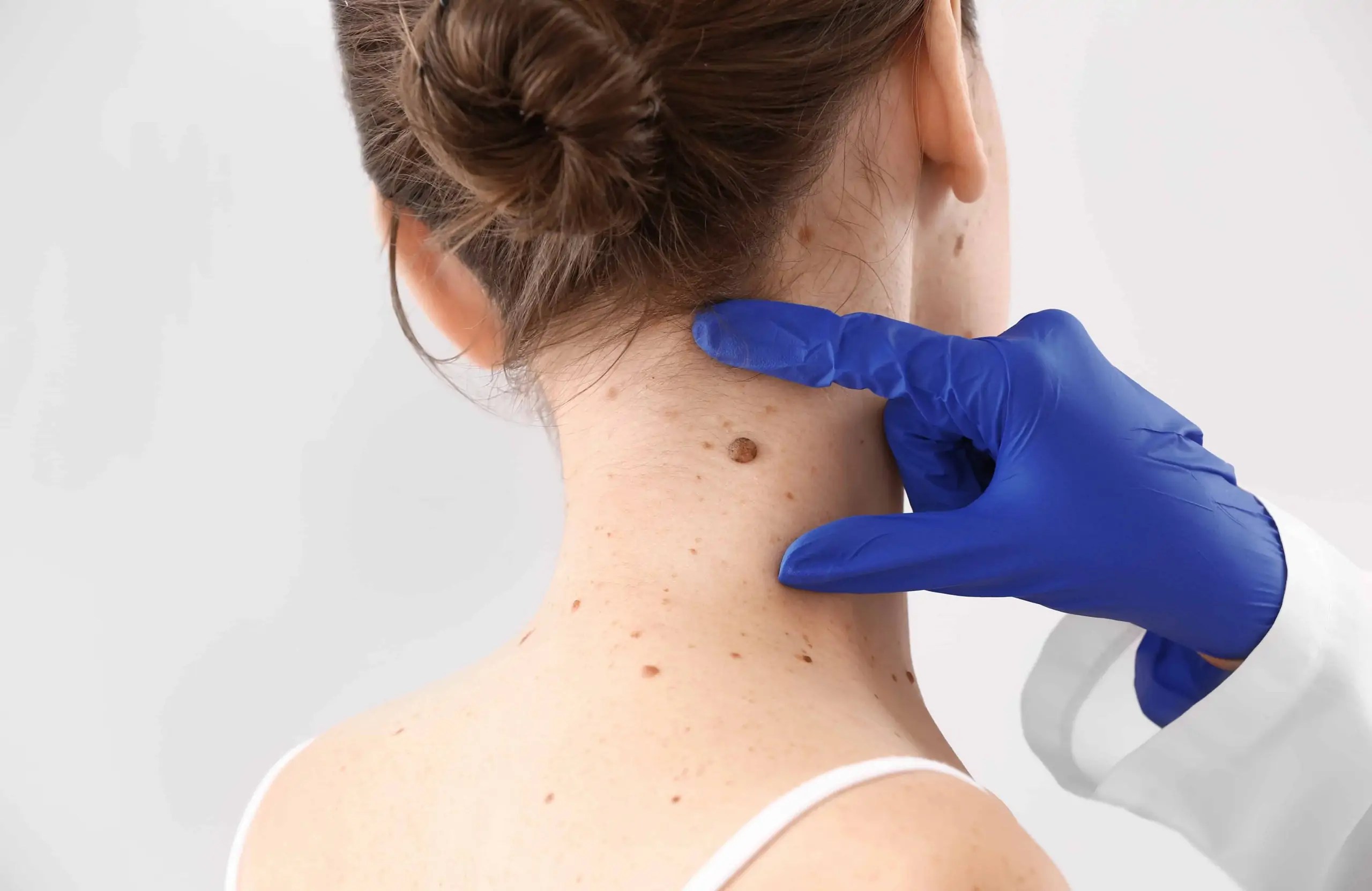 How Much Does It Cost To Remove A Mole Without Insurance