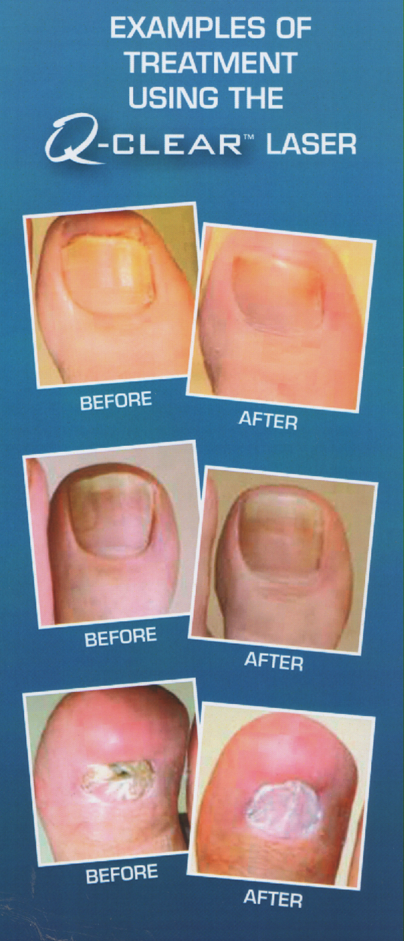 The Latest Thinking on Toenail Fungus Healthy Running