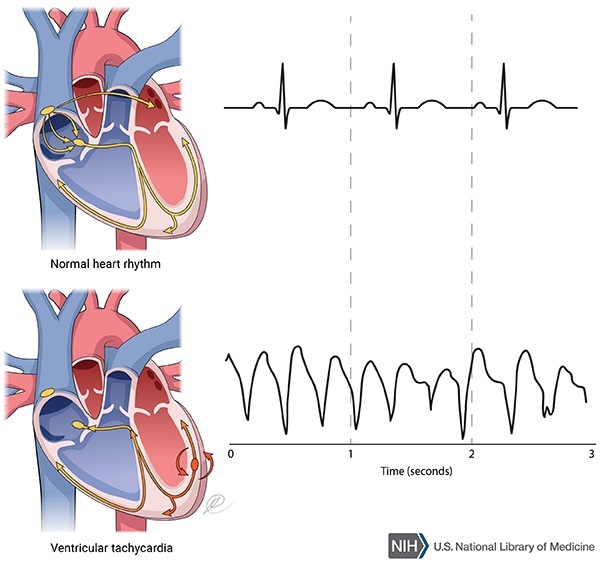 Heart Conditions Heart Research Australia