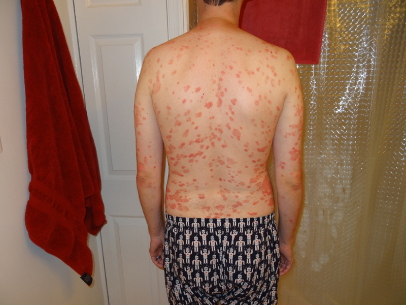 Switching from Humira to Stelara Inspire
