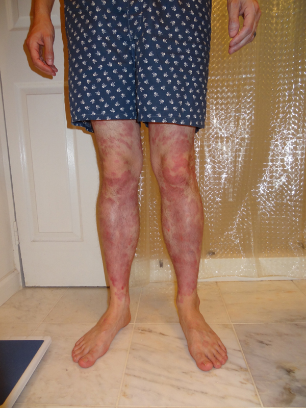 Switching from Humira to Stelara Psoriasis Inspire