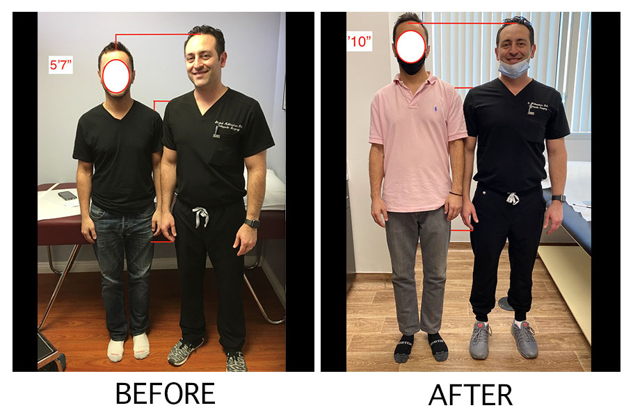 Before & After Gallery Height Lengthening