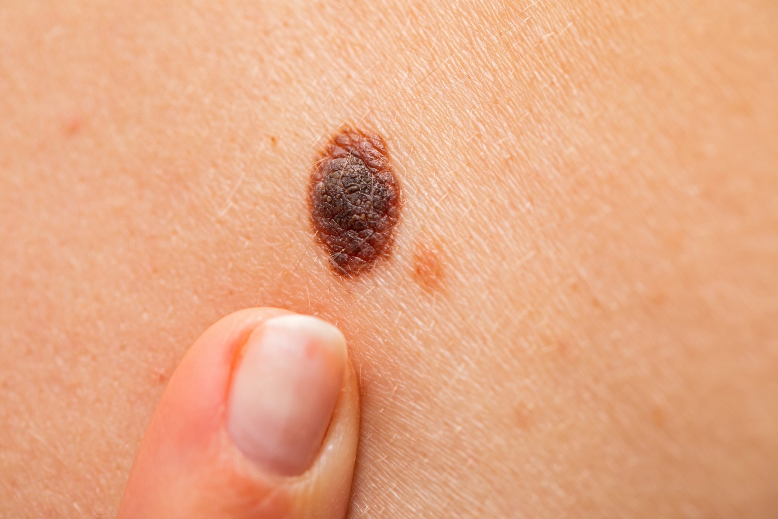 Hautkrebs Neuer Test erkennt MelanomZellen im Blut Heilpraxis
