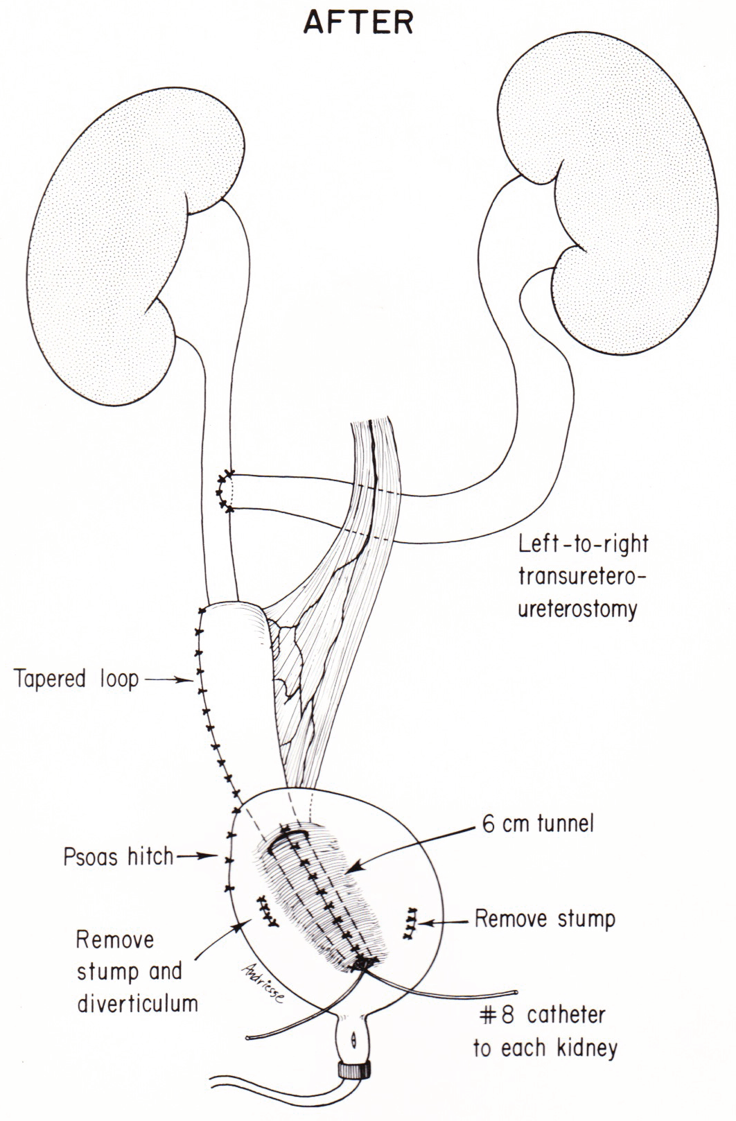 Urinary Tract Reconstruction Patient 5 Undiversion by Removing an