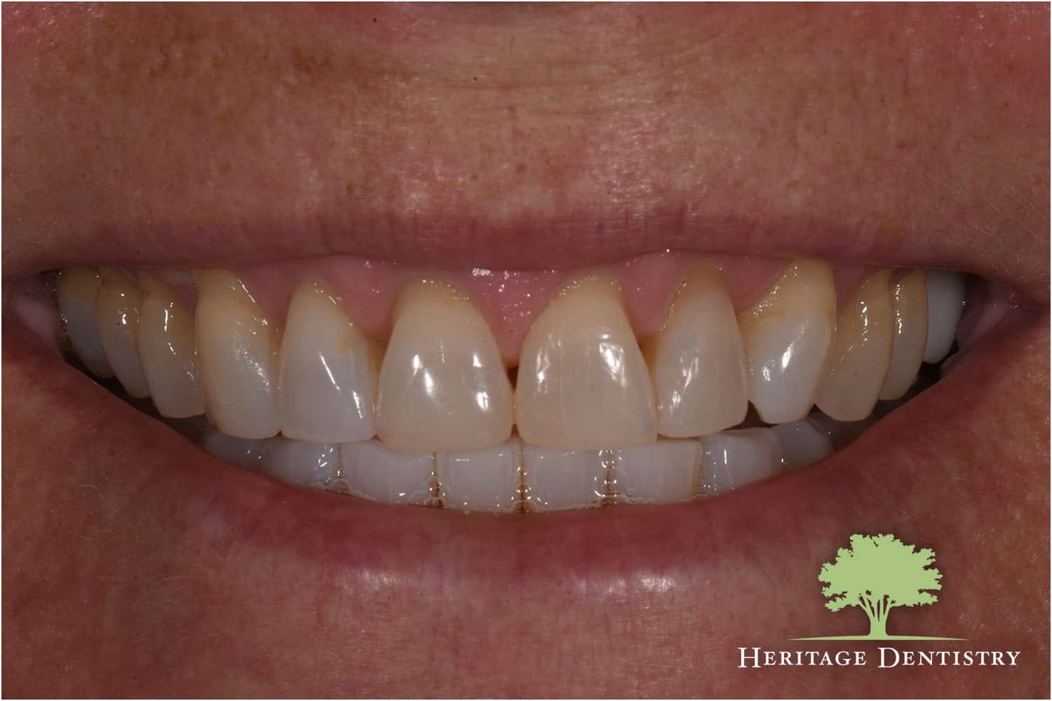 Porcelain Veneers Greenville SC Heritage Family Dentistry
