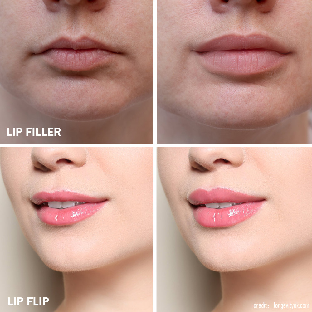 How to Choose between a LipFlip and LipFillers Her Style Code