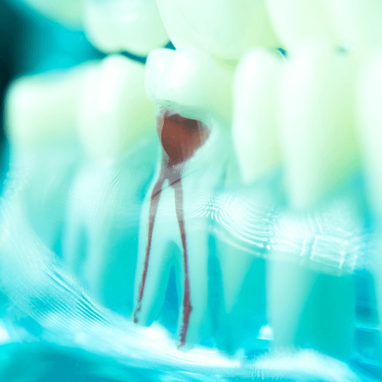 Endodontist in Raleigh, NC Canals Misleading Myths