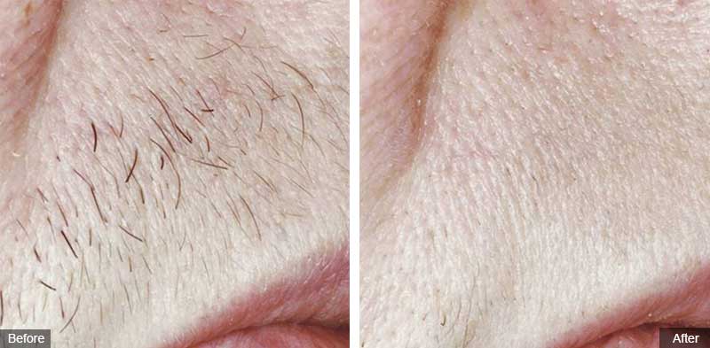 Laser Hair Removal Patricia Hickham