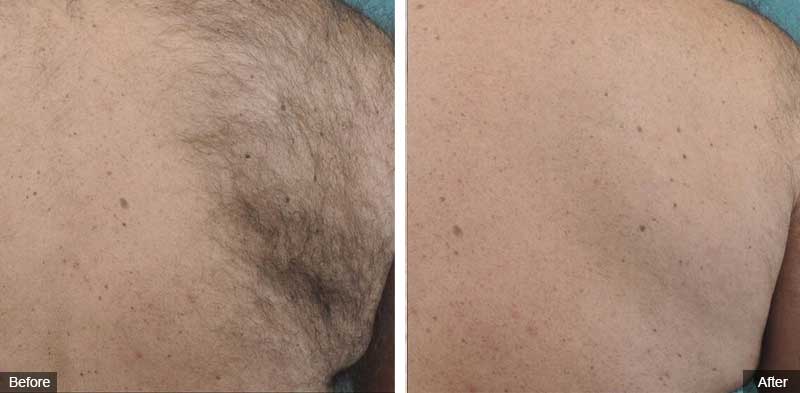 Laser Hair Removal Patricia Hickham