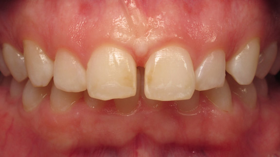 Before and After Photos Hickory, NC Hickory Dental Care