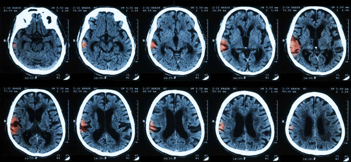 St. Louis Workers Compensation Attorney Intracranial Injury and Work Comp