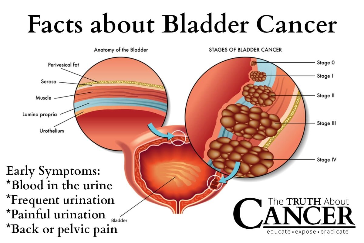 Bladder Cancer Signs, Symptoms And Causes Home Remedies