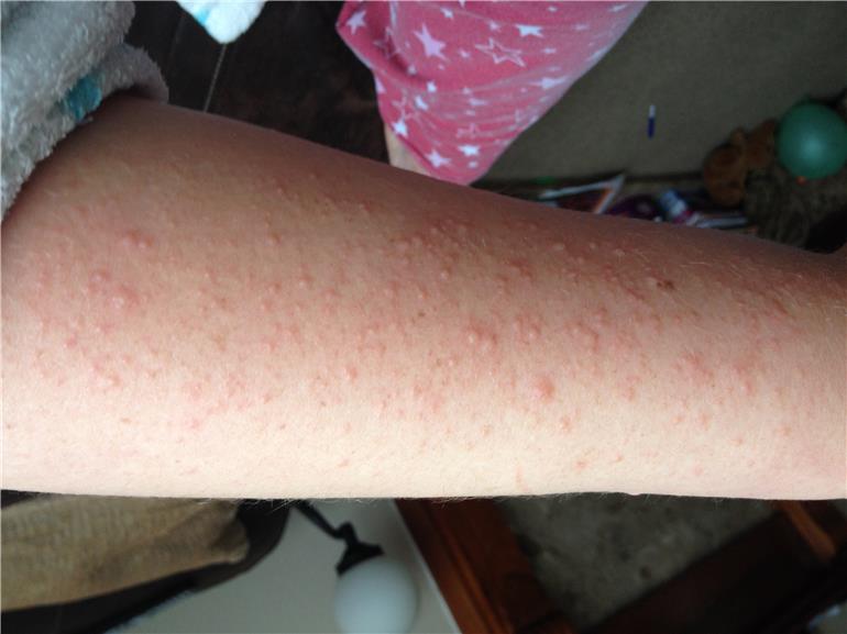 Polymorphous Light Eruption Symptoms, Causes & Risk Factors