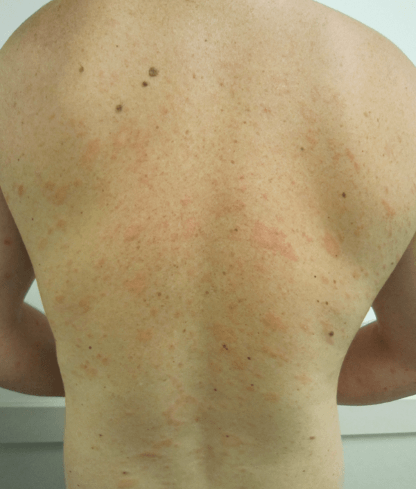 Seborrheic Dermatitis Symptoms, Causes And Other Risk Factors