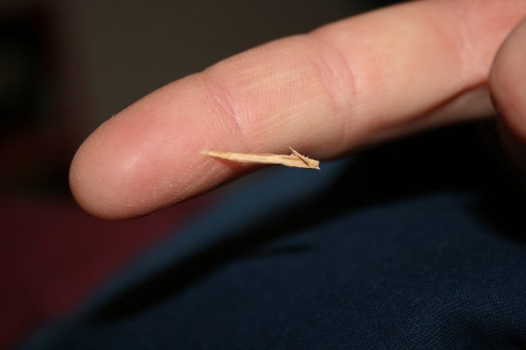 Splinters Causes, Symptoms And Other Associated Risk Factors