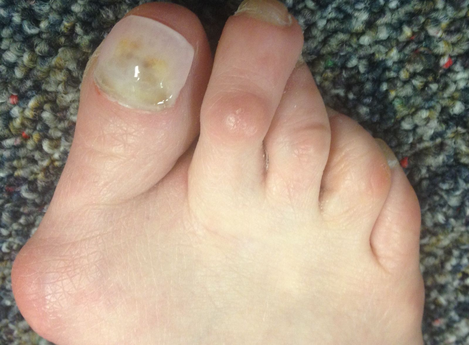 Bunion Symptoms, Causes and Risk factors Home Remedies