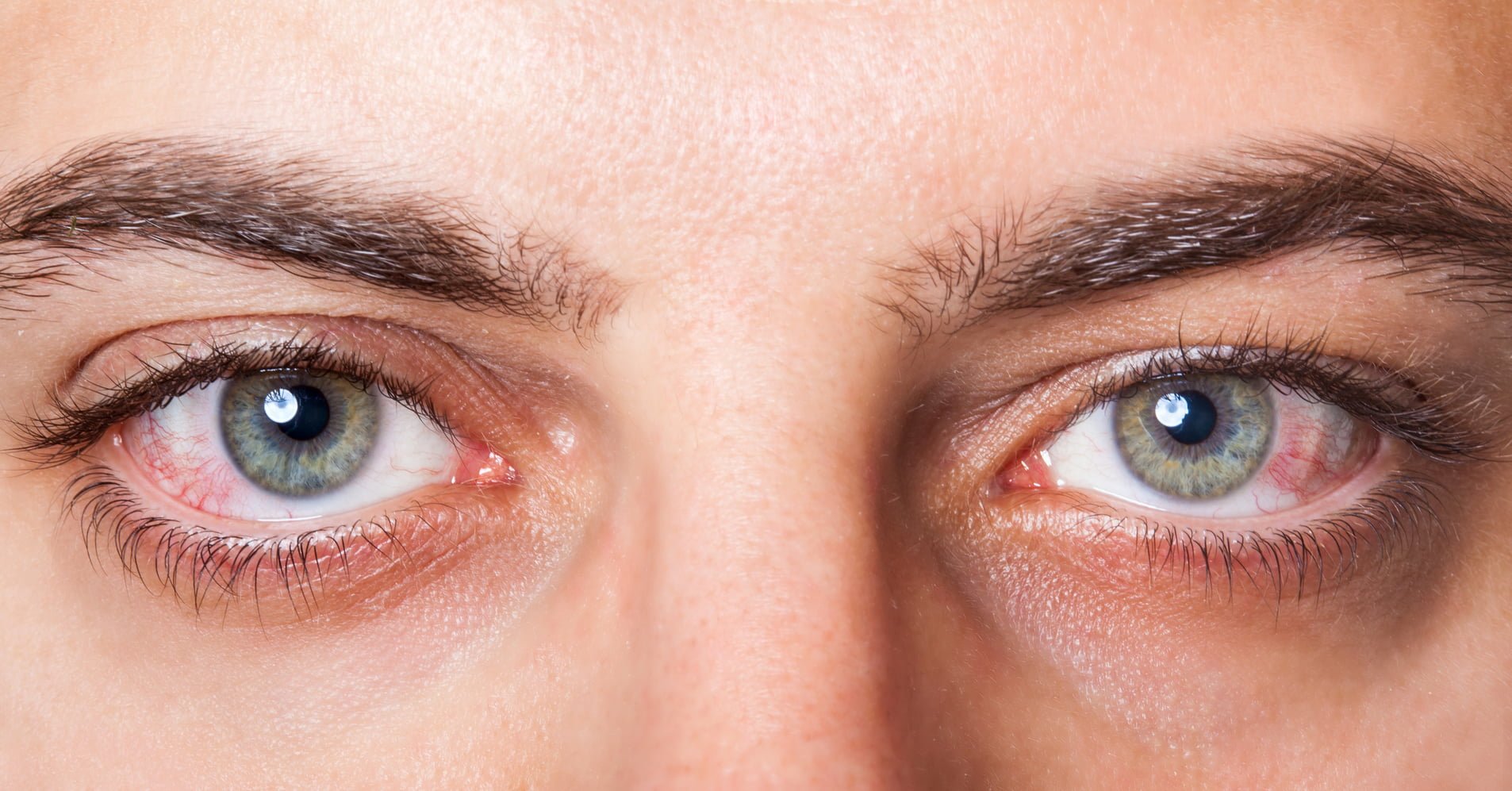 Dry Eyes Symptoms, Causes, Risk Factors And Complications