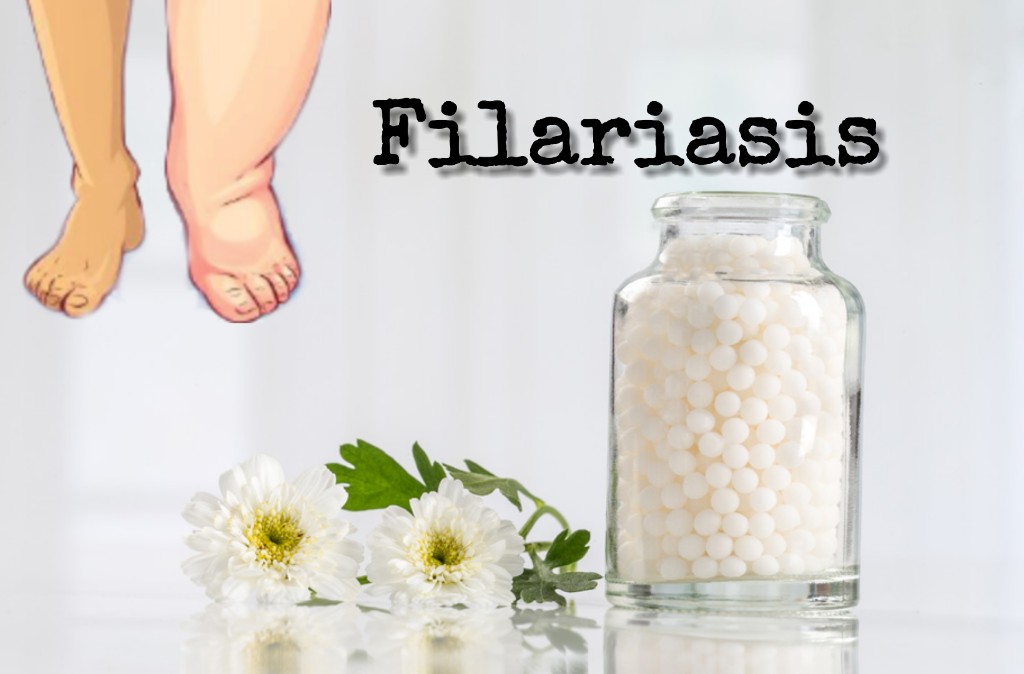 Homeopathic Treatment, Medicines, Remedies for Filariasis