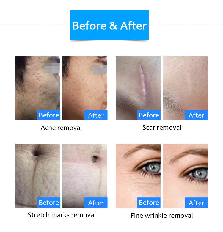 WZ02 PRO Scar Acne Removal Antiaging Microneedle Beauty Machine