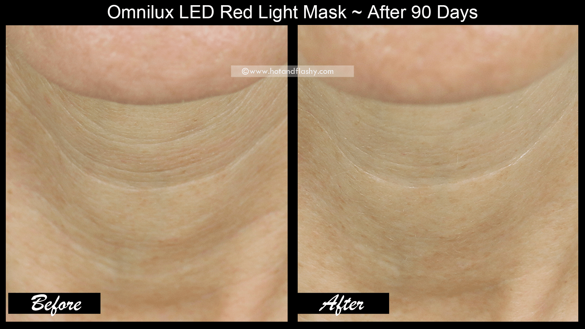 OmniLux LED Mask 3 Month Results! Before & After Face, Neck, & Hand
