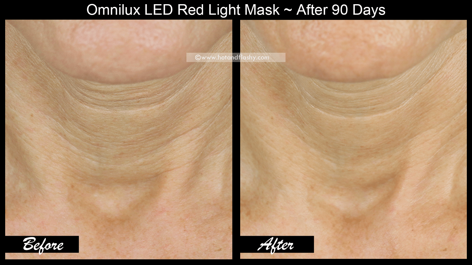 OmniLux LED Mask 3 Month Results! Before & After Face, Neck, & Hand